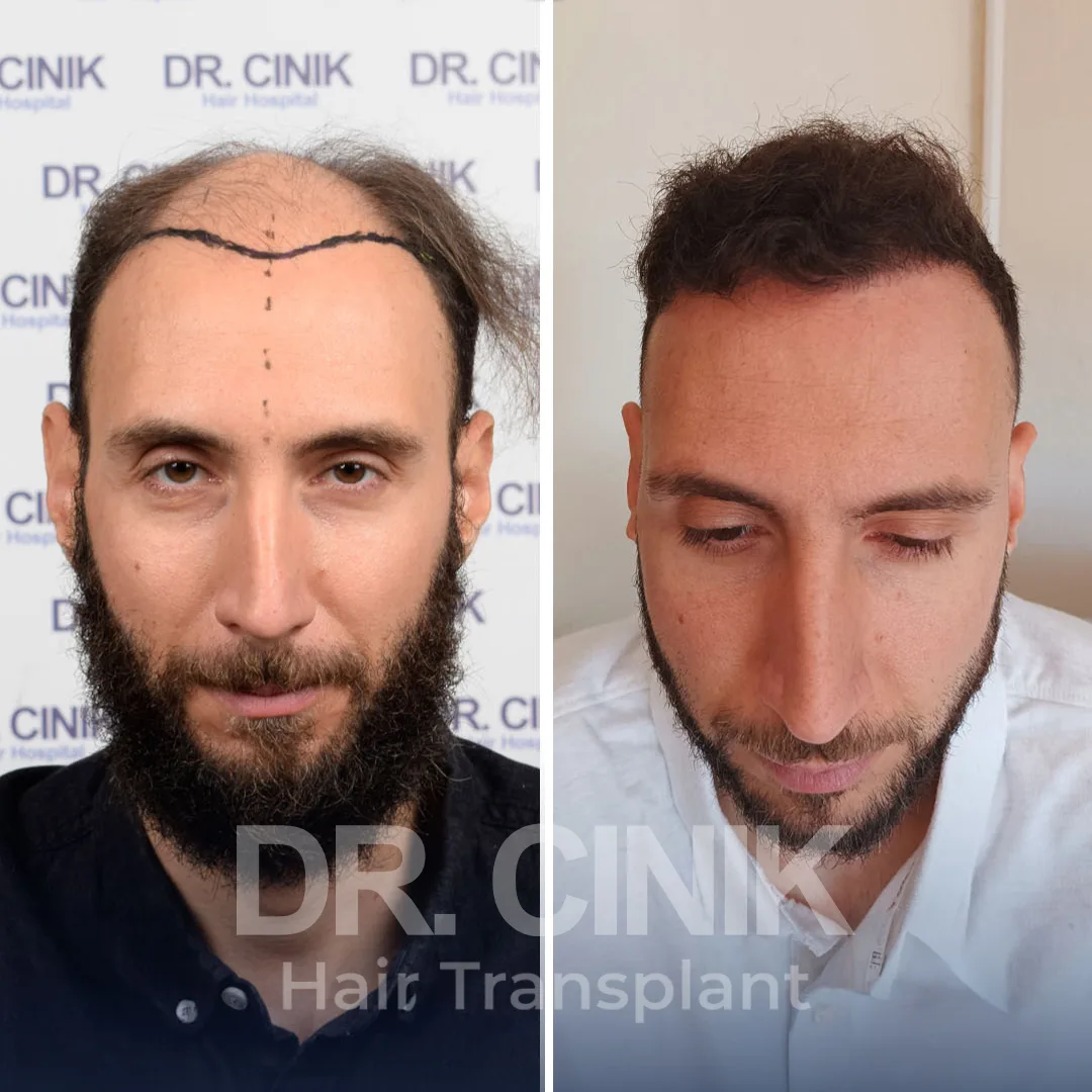 Hair Transplant