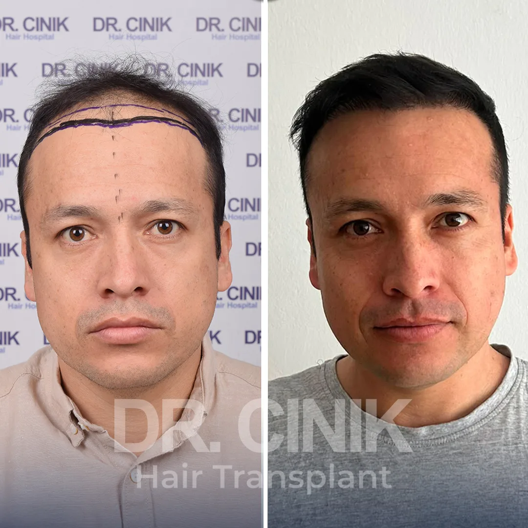 Haartransplantation