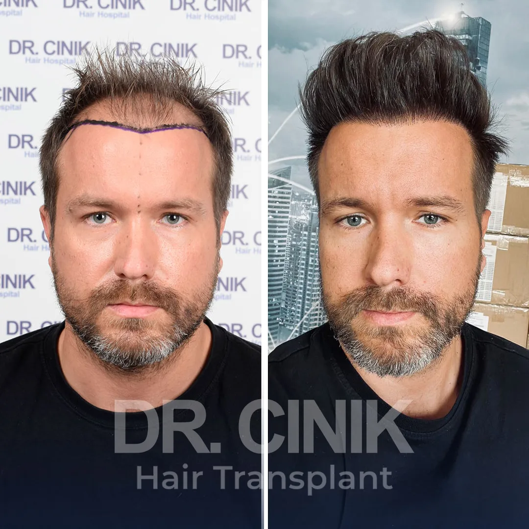 Hair Transplant
