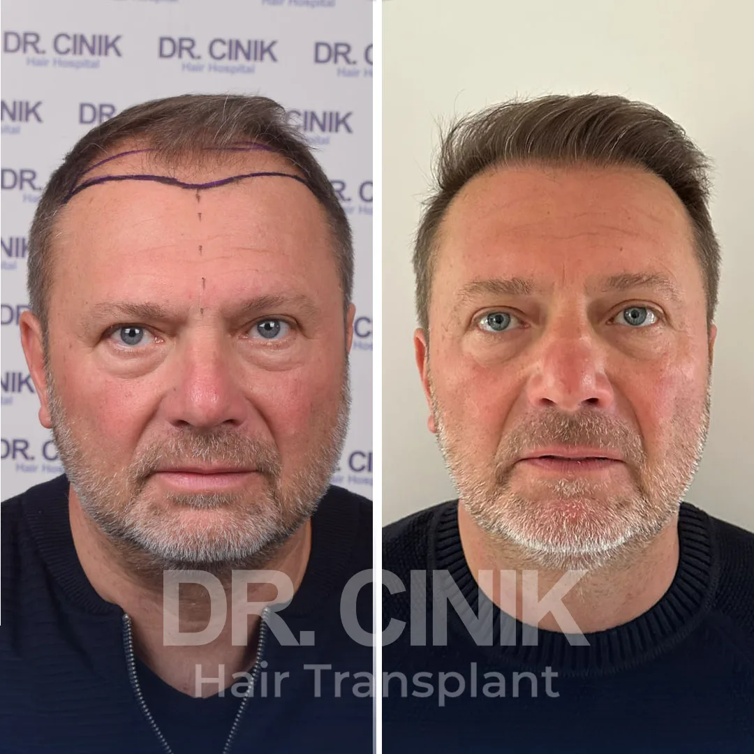 Haartransplantation