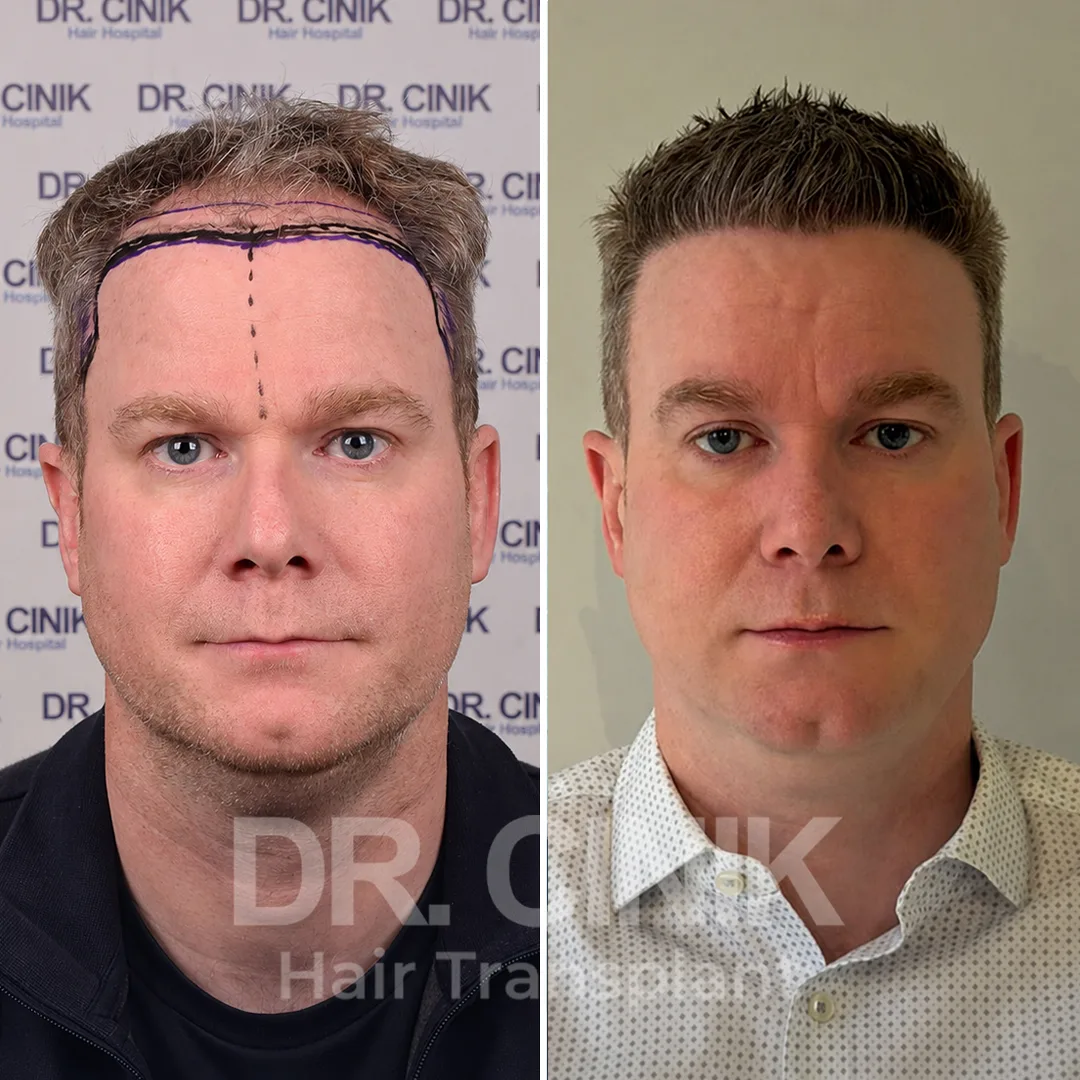 Haartransplantation