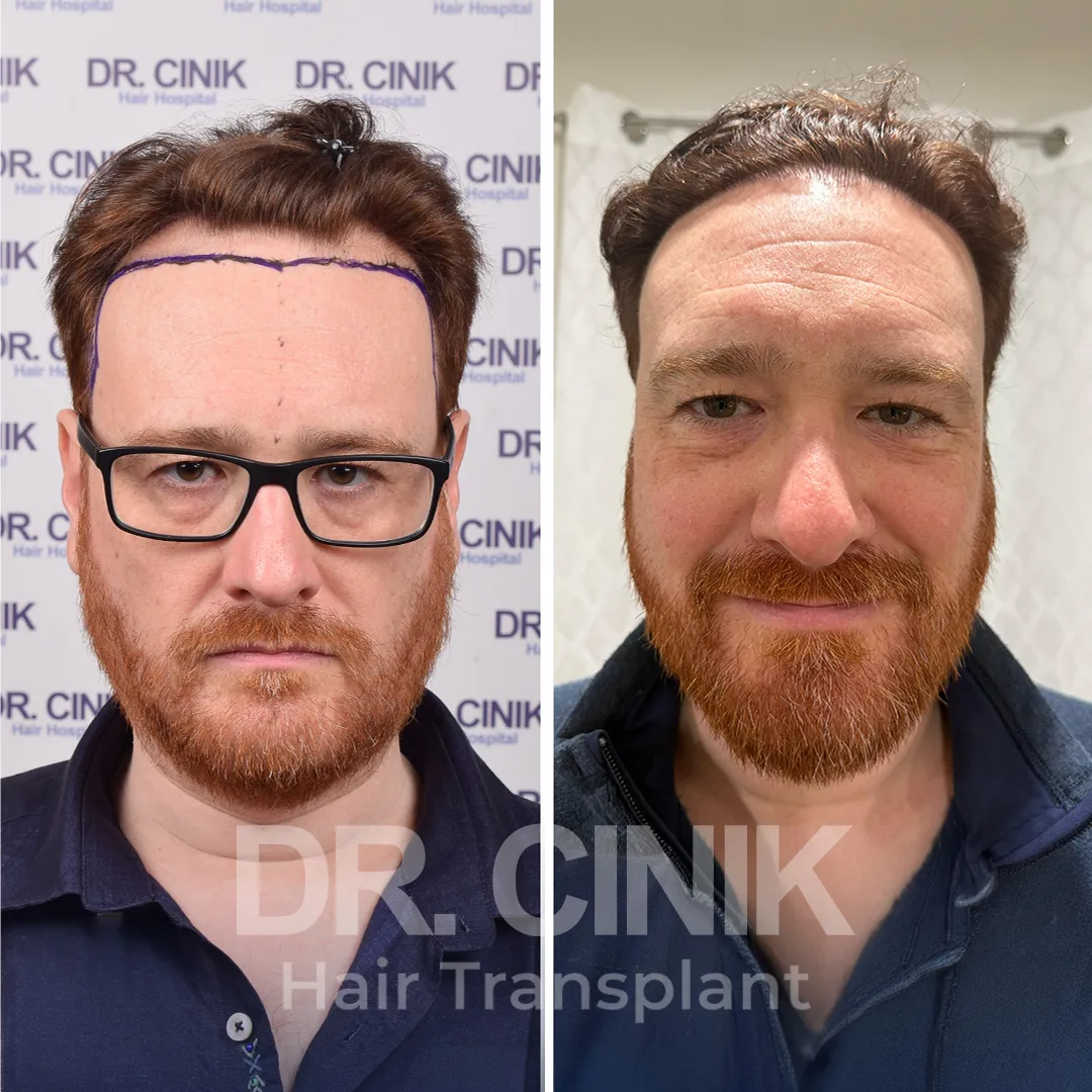 Haartransplantation