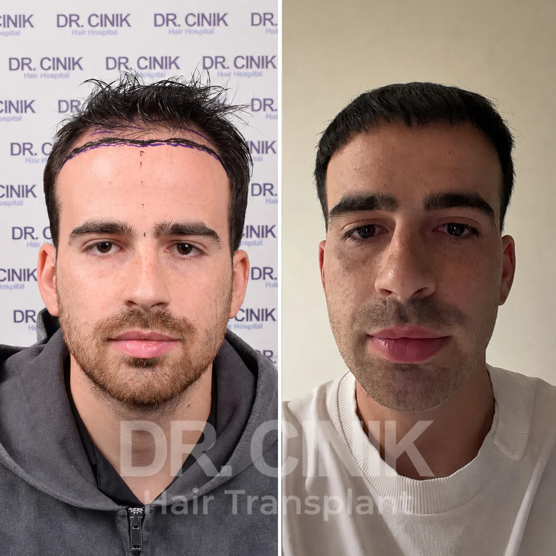 Haartransplantation
