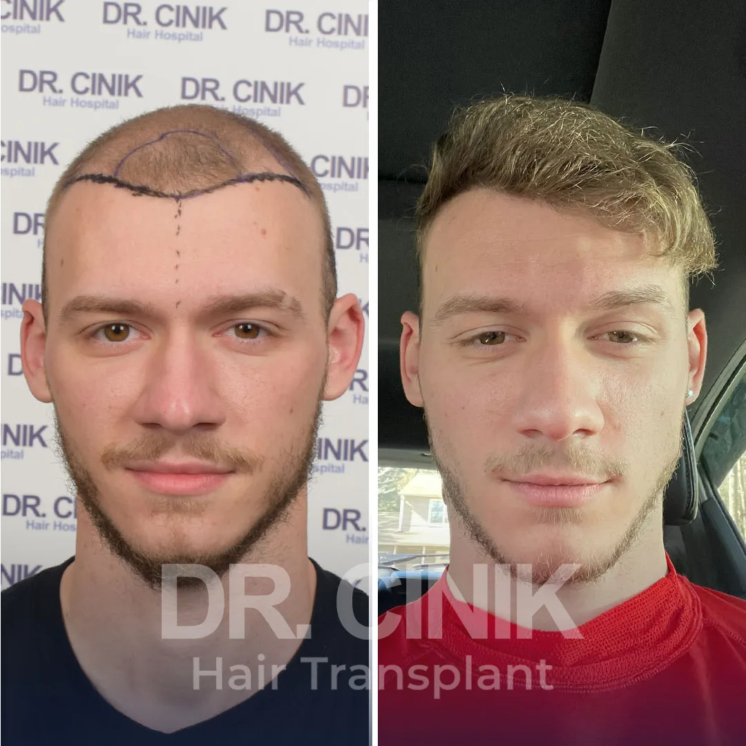 Hair Transplant