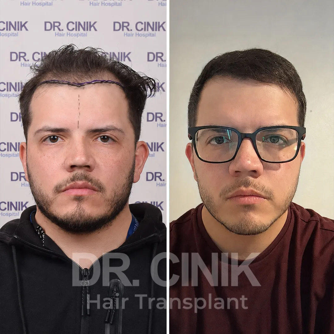 Haartransplantation