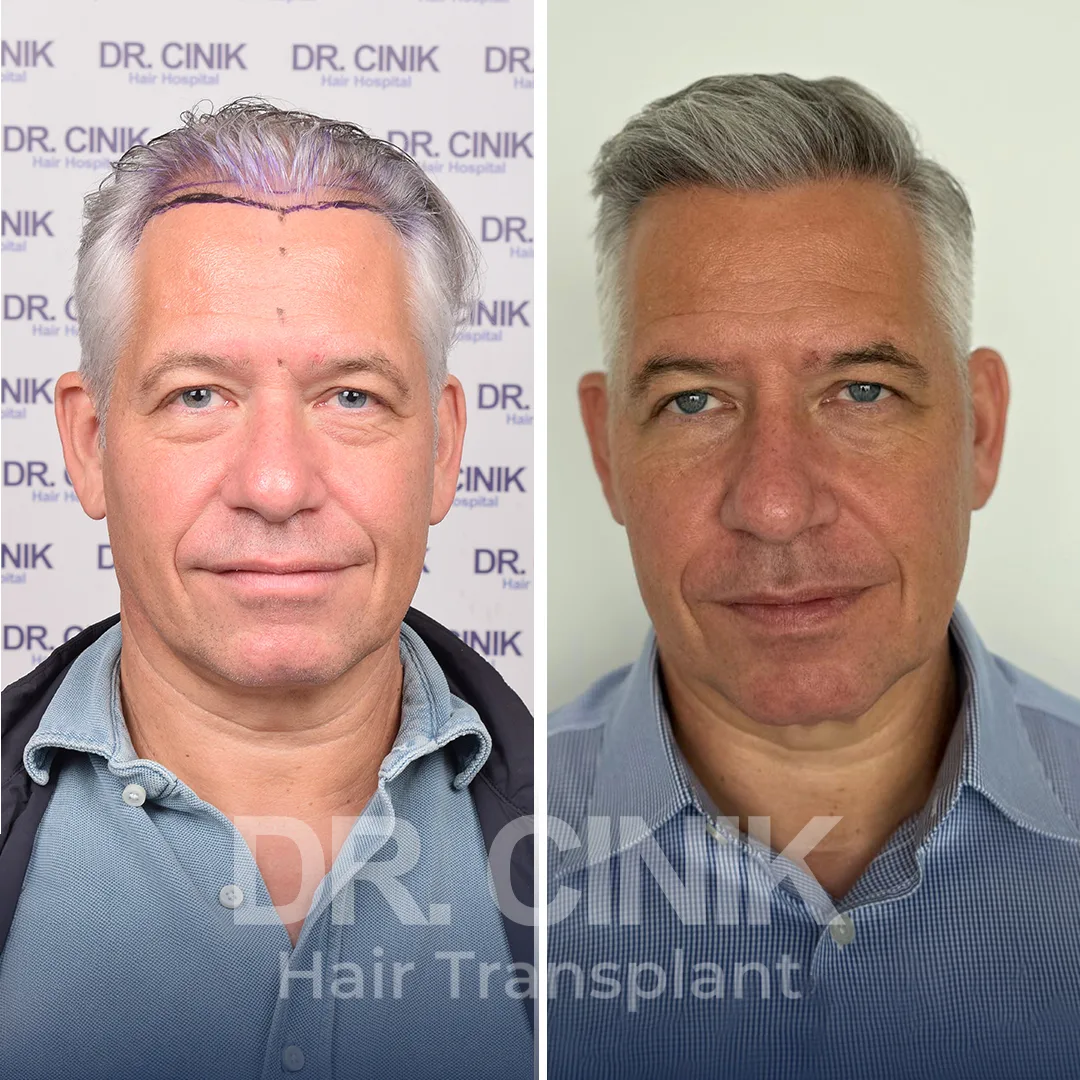 Haaretransplantation