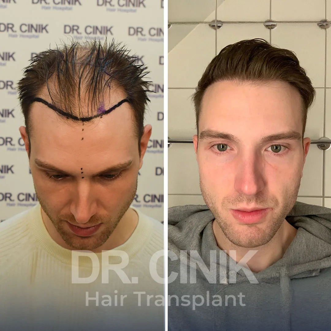 Hair Transplant