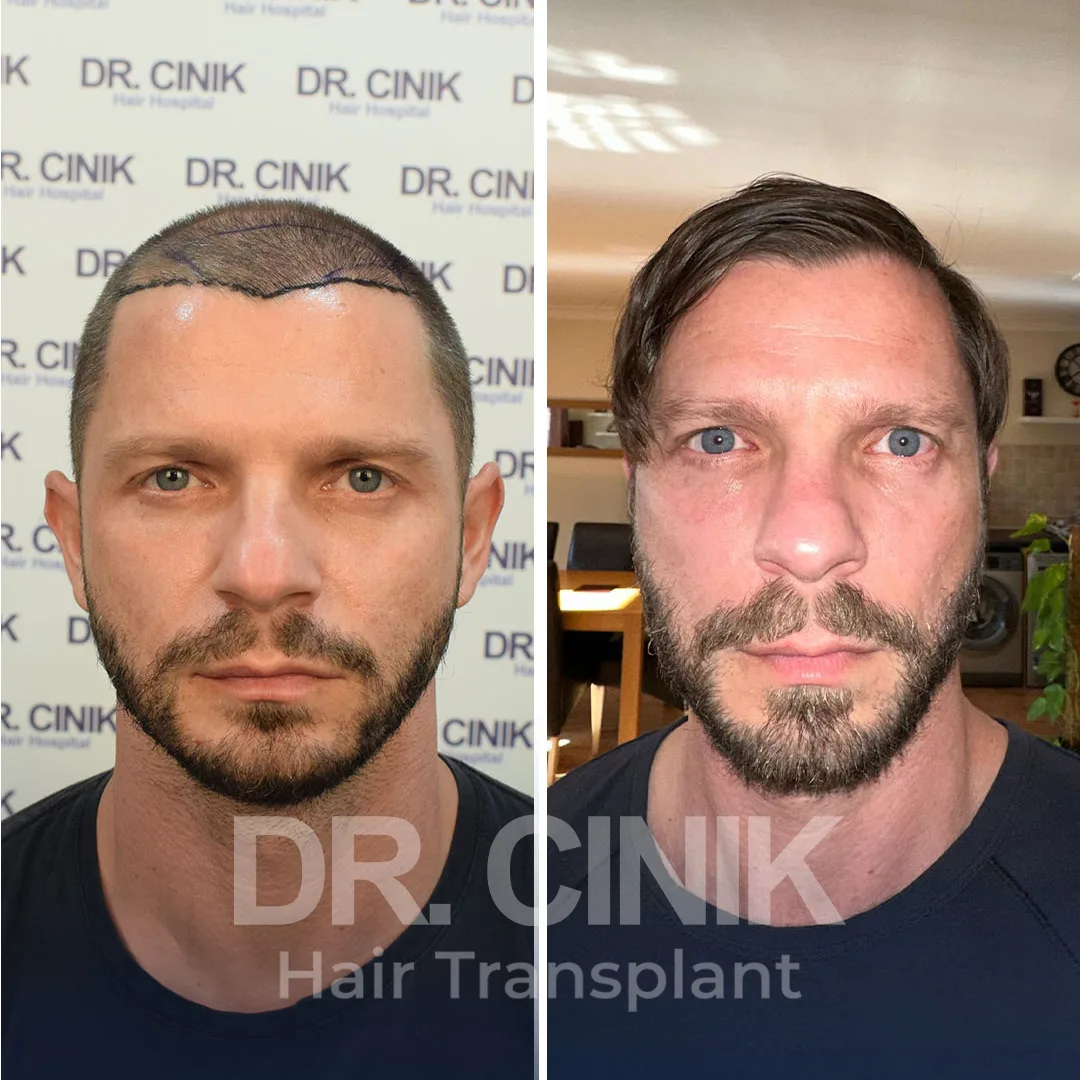 Hair Transplant
