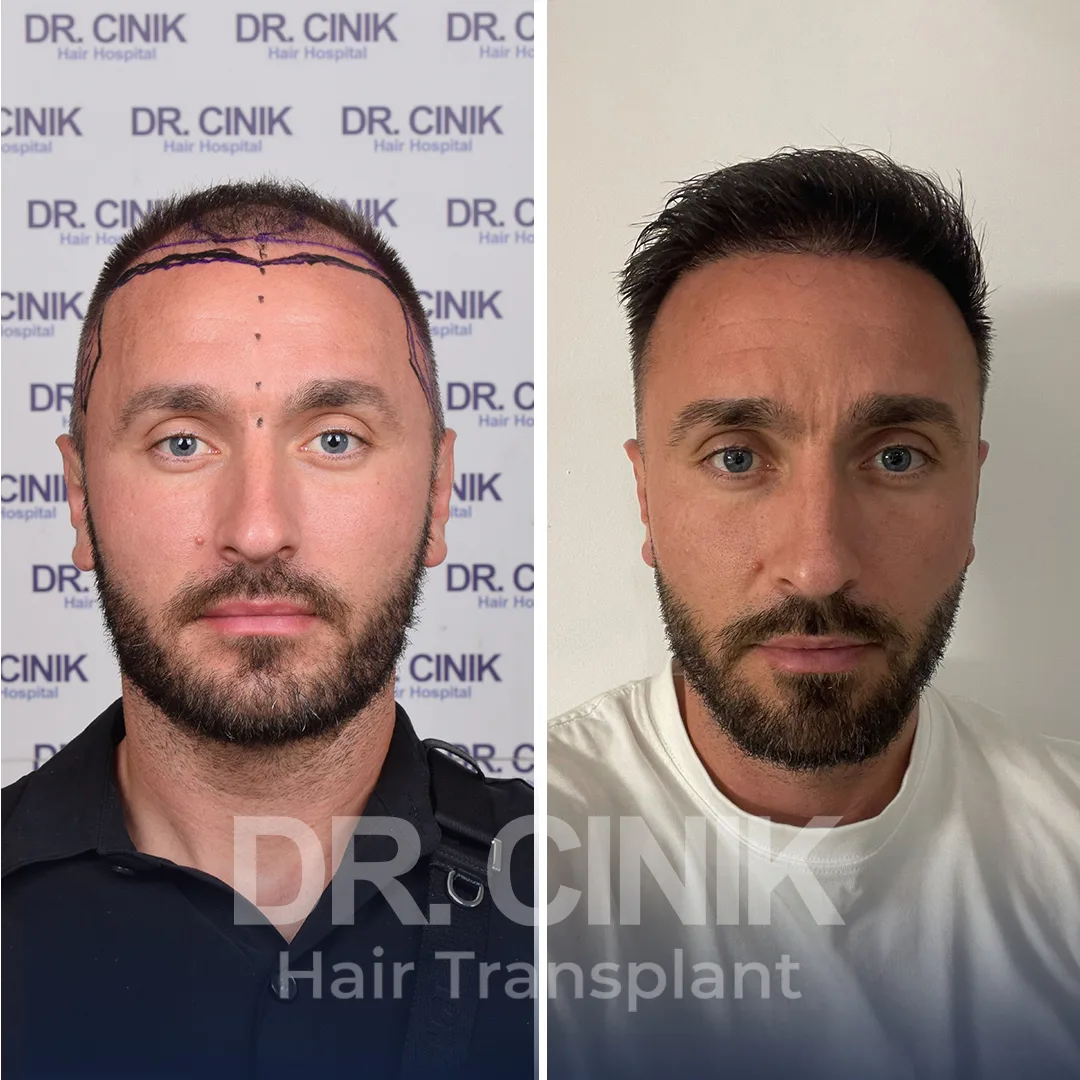 Haartransplantation