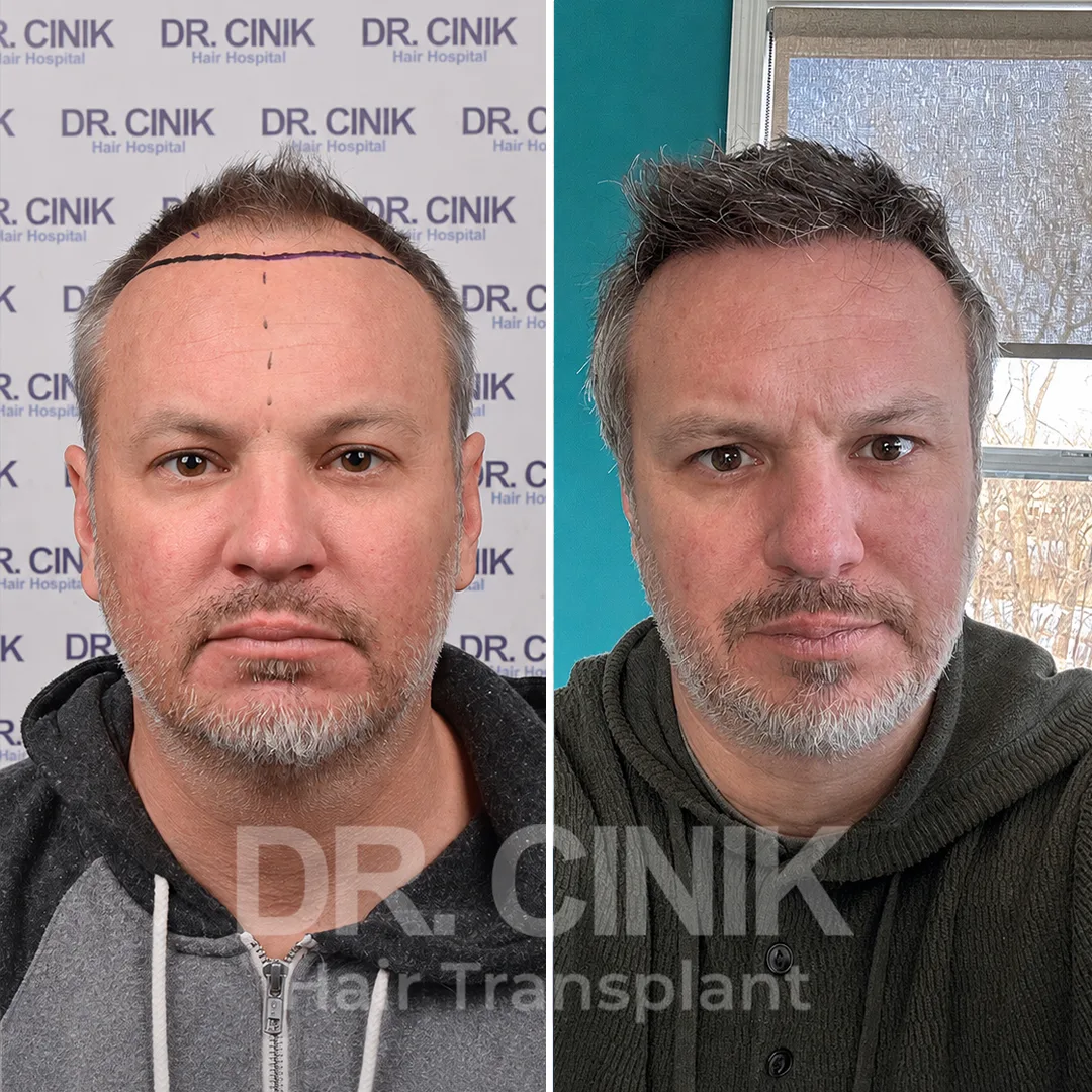 Haartransplantation