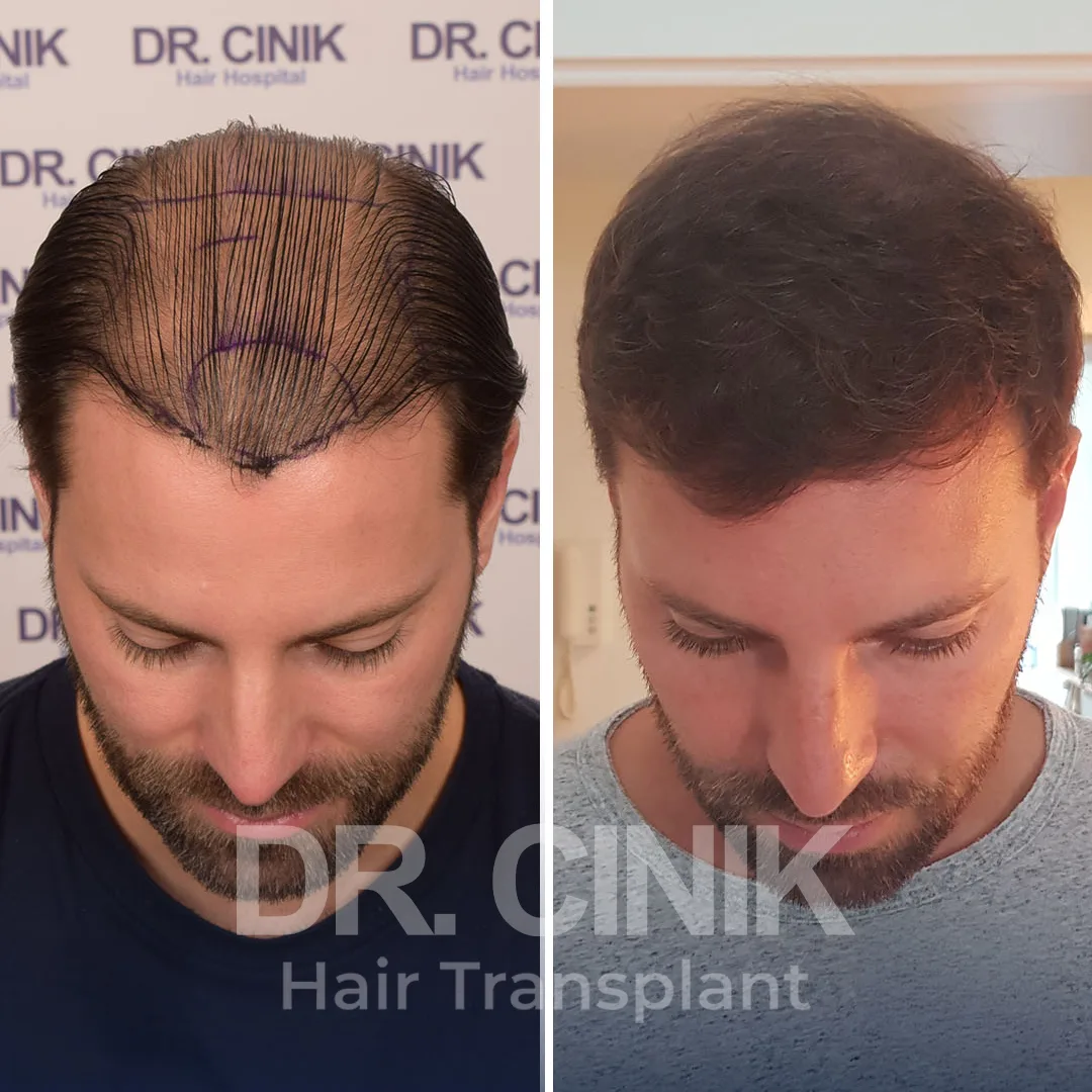 Hair Transplant
