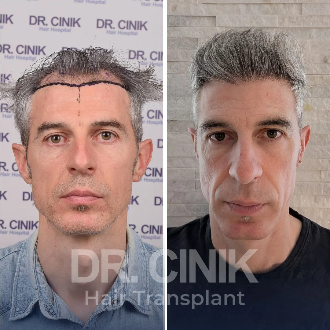 Haaretransplantation