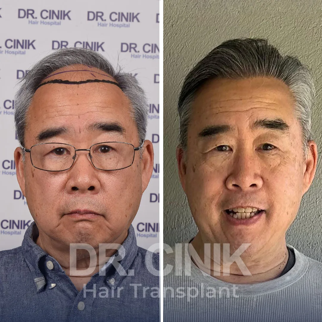 Haaretransplantation