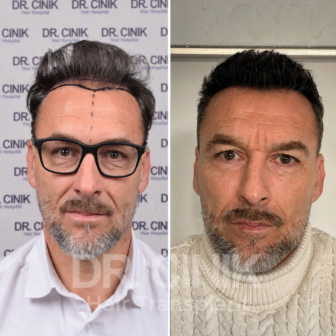 Haartransplantation