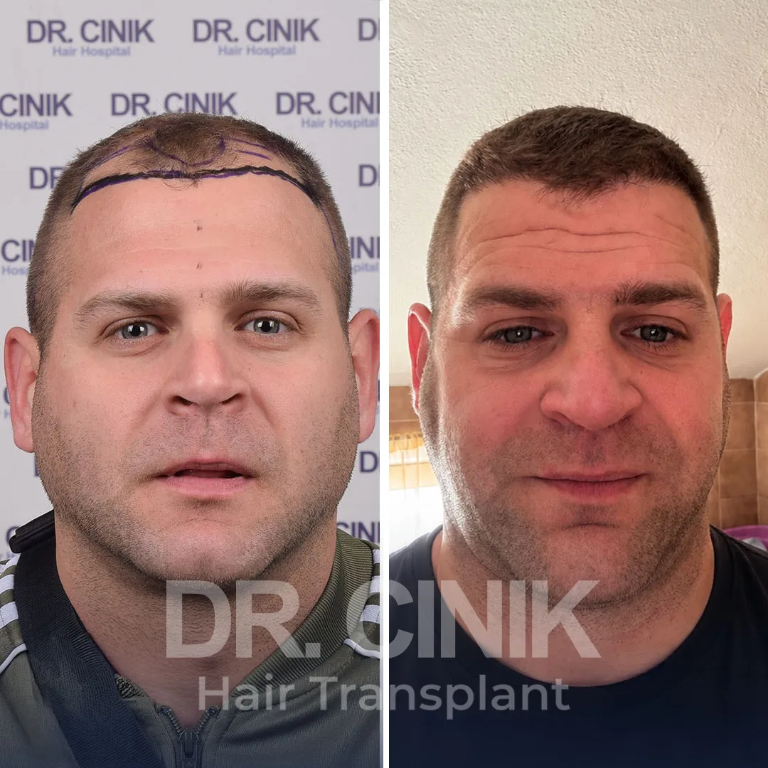 Haaretransplantation