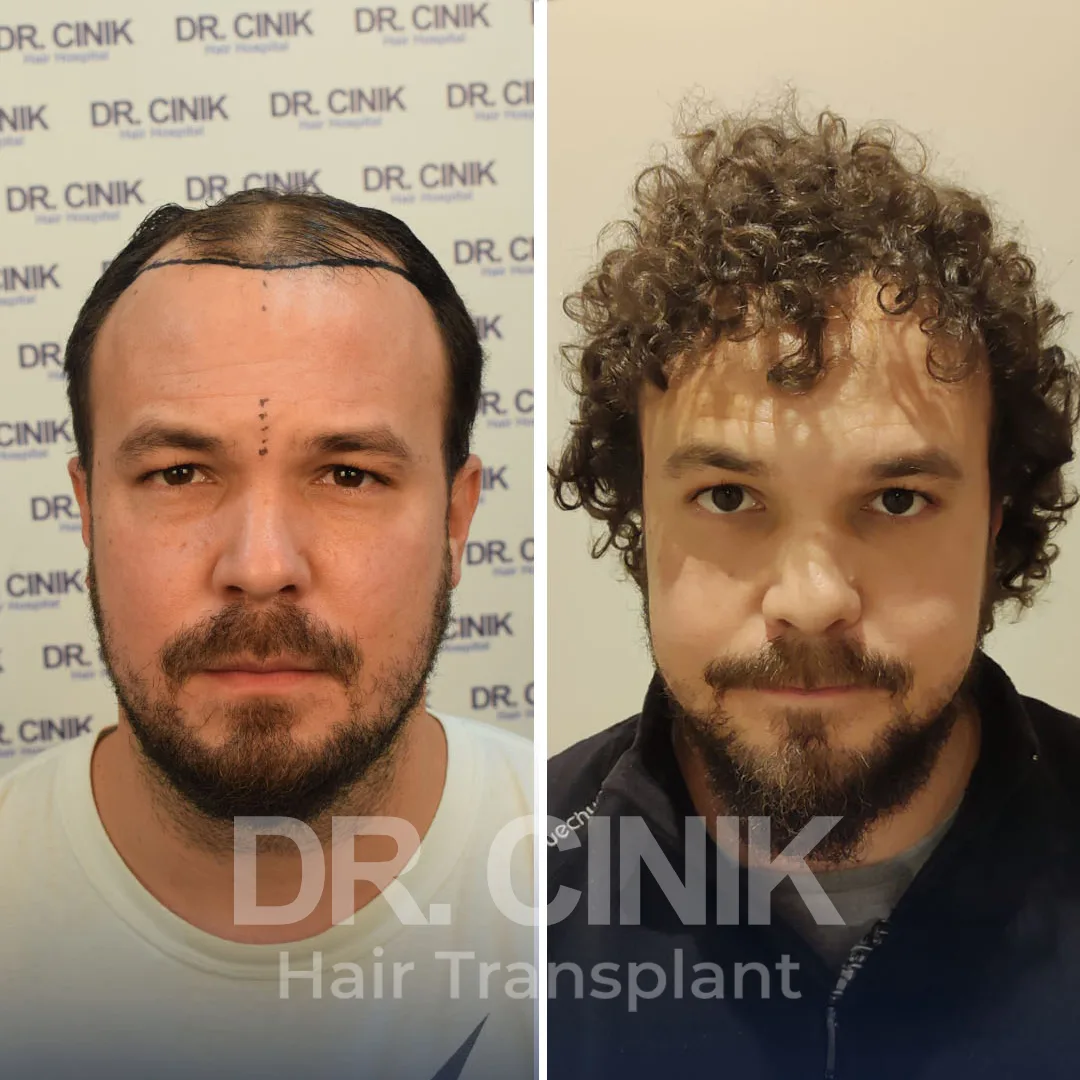 Hair Transplant