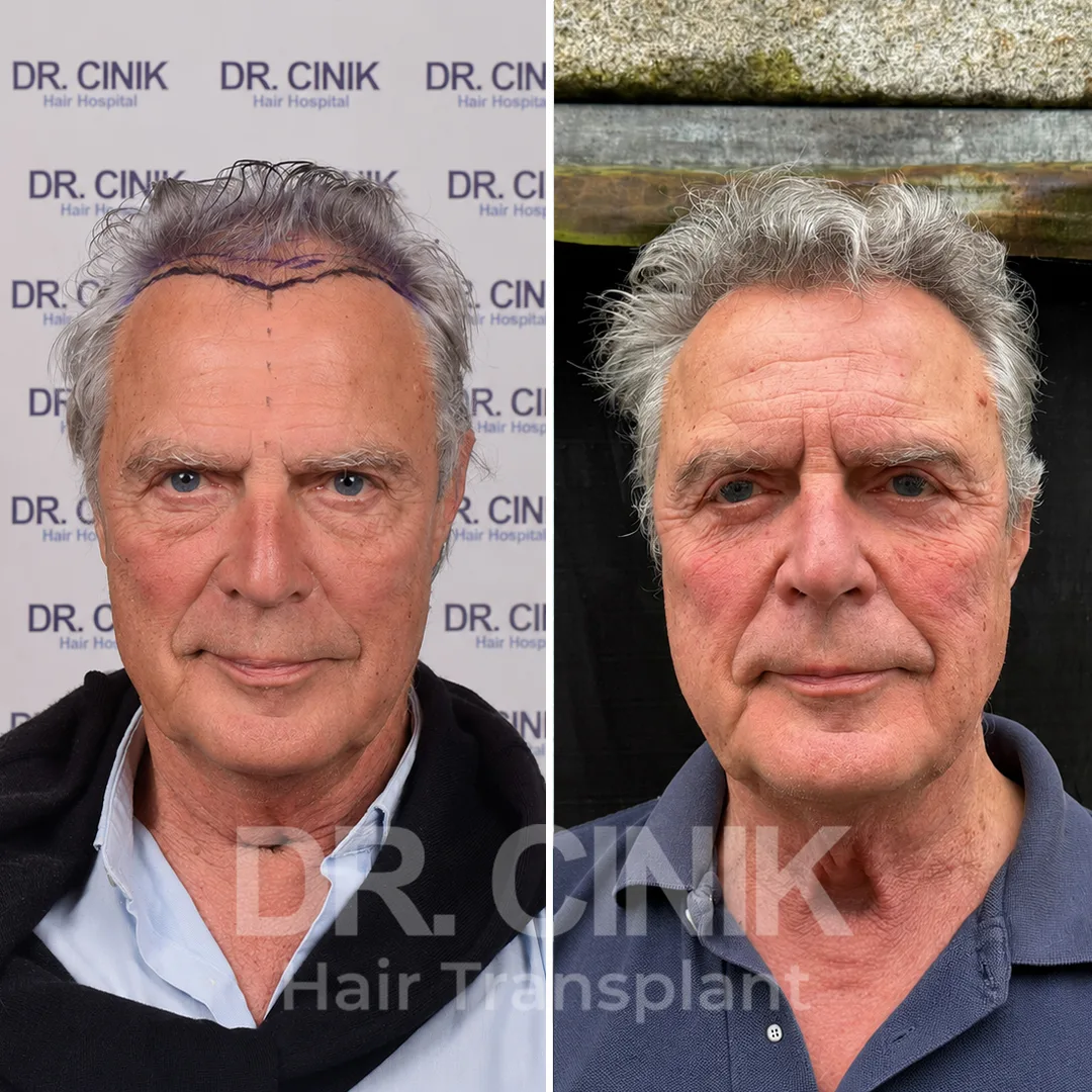 Haartransplantation