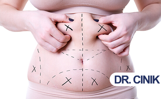 Liposuction