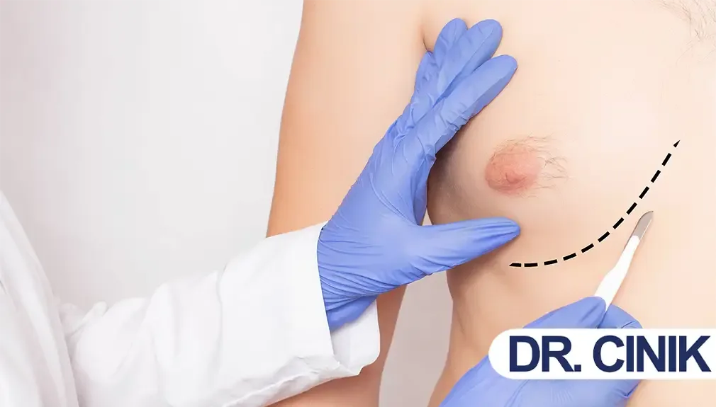 Chirurgie de la gynécomastie