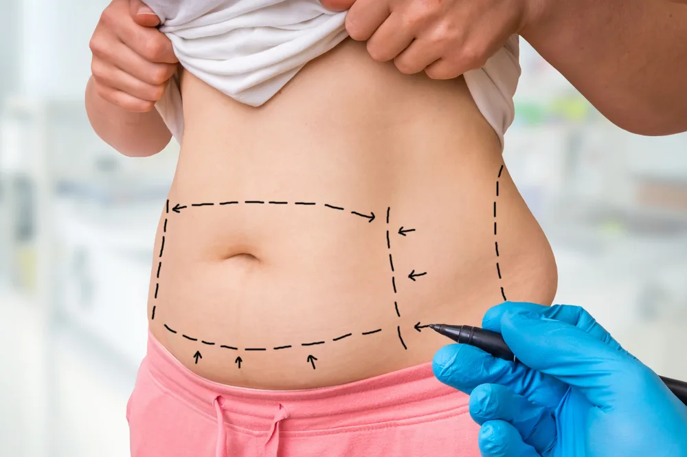 Abdominoplastie